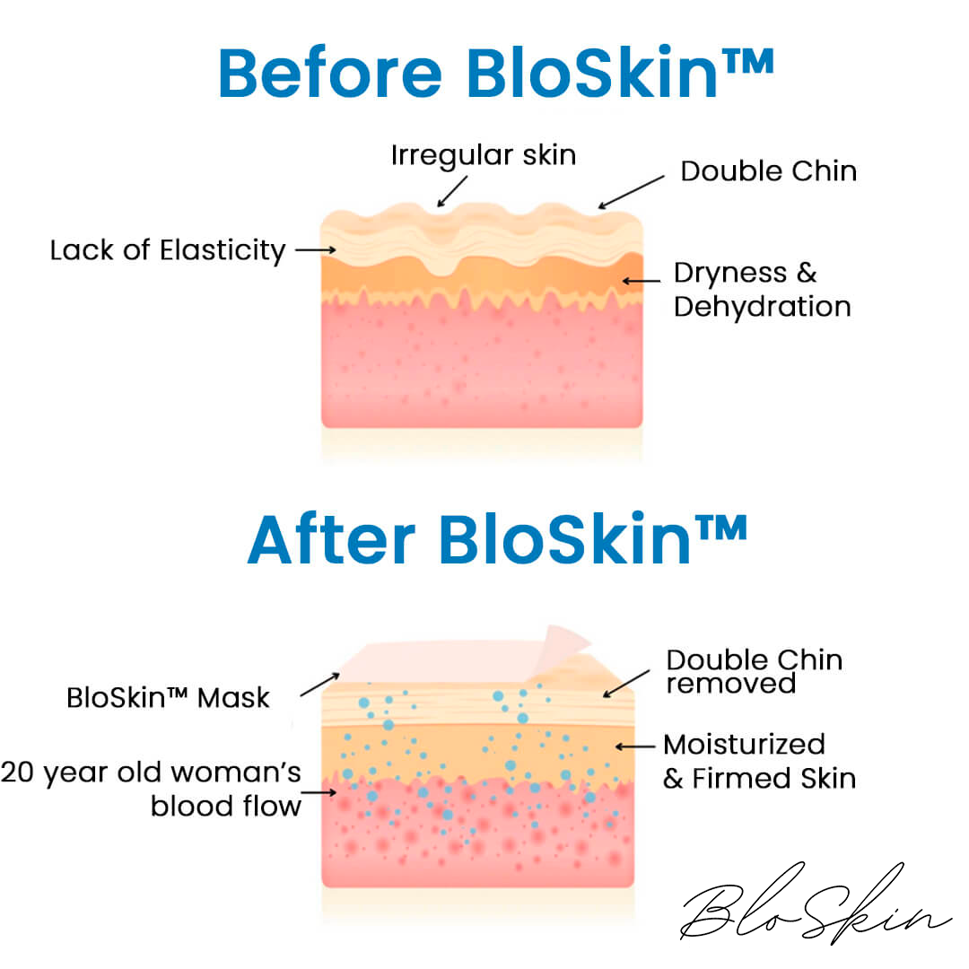 The BloSkin™ Lift : Say goodbye to your double chin now